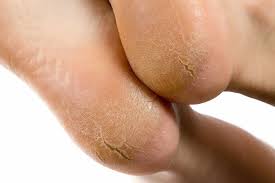 Heel fissure case study